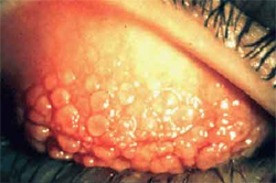 צילום הלחמית בצד הפנימי של העפעף העליון בחולה עם דלקת אביבית וקרטוקונוס. בלחמית גושי תאים בצורת "יבלות" או "אבני מרצפת".