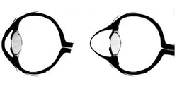 תרשים של חתך בעין קרטוקונית מימין ועין נורמלית משמאל.