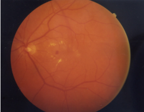תמונה ימנית – עין של חולה בן 76 עם ירידה בראייה של צמיחת כלי דם במרכז הראייה בשל ניוון רתית הקשור לגיל.