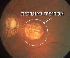 אטרופיה גיאוגרפית רשתית