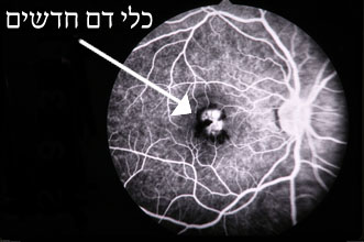 כלי דם חדשים ברשתית