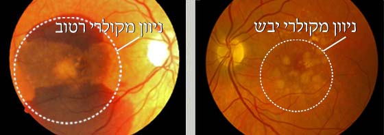 ניוון מקולרי