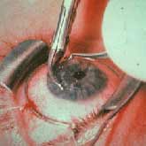 חיתוך וכריתה של מרכז הקרנית הקרטוקונית בניתוח השתלת קרנית.