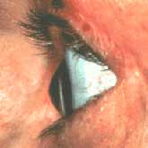 צילום מהצד של עין עם קרטוקונוס. צורה חרוטית של הקרנית.